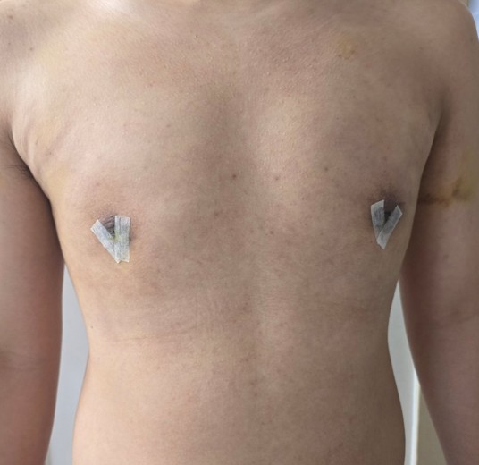 after photo: 여유증수술