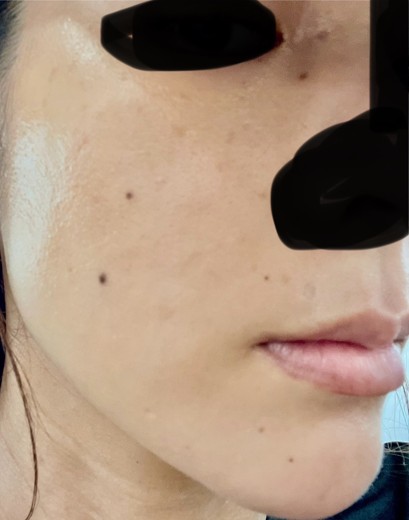 before photo: CO2レーザー, ほくろ除去(レーザー), QスイッチYAGレーザー(CuRAS Hybrid)