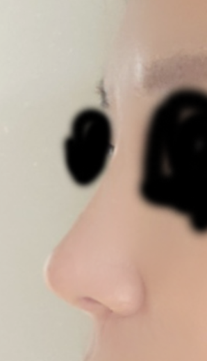 after photo: 콧대(보형물), 코끝(자가연골)