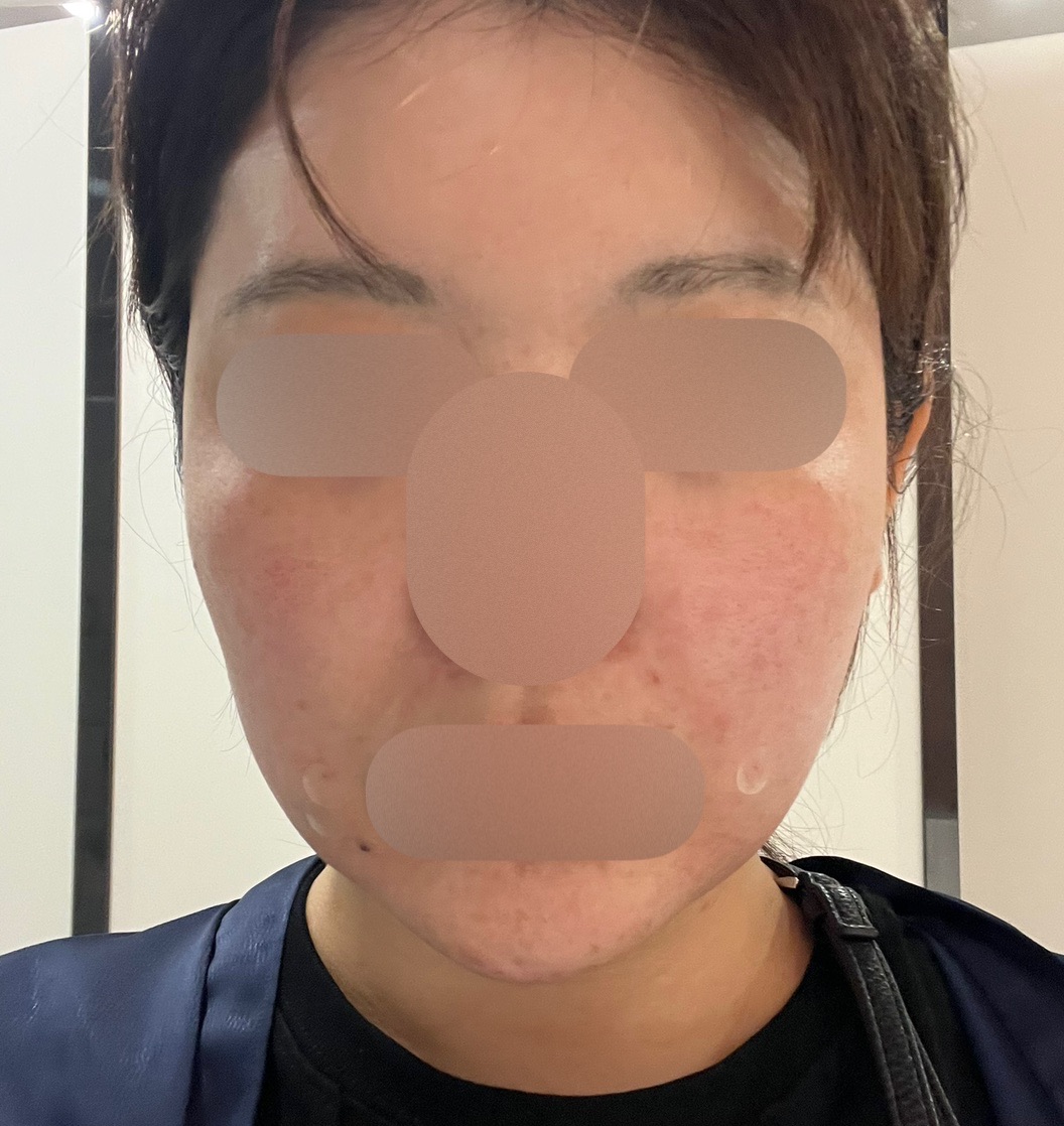 痛みを最小限に抑えたエラビエリトゥオ, リジュラン フルフェイス