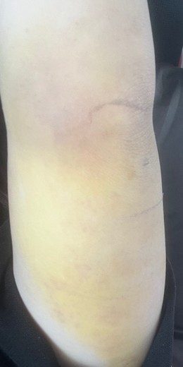 after photo: 脂肪吸引(腕)
