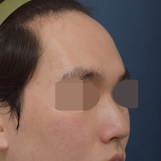 before photo: 콧대(자가조직), 코끝(자가연골)
