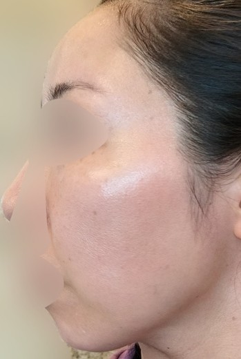 before photo: ルメッカ