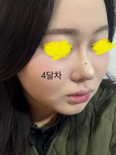 after photo: 콧대(보형물), 코끝(자가연골), 비후성비염수술