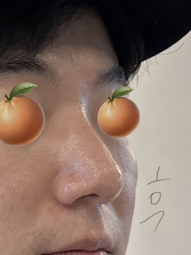 after photo: 콧대(보형물), 코끝(자가연골), 비후성비염수술