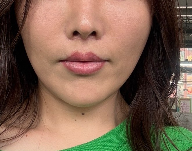 after photo: ピコトーニング