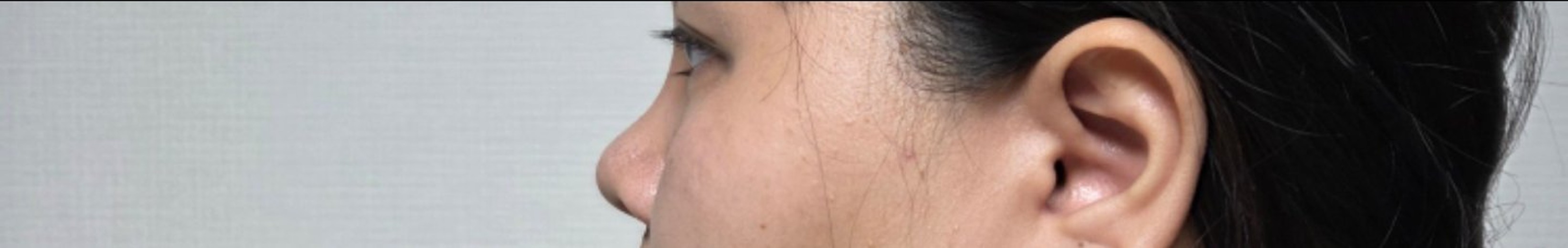 after photo: 비중격만곡증수술, 코끝(보형물)