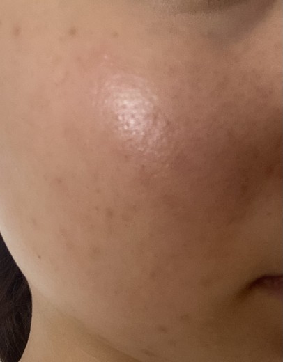 after photo: ダーマペン, ミラノリピール