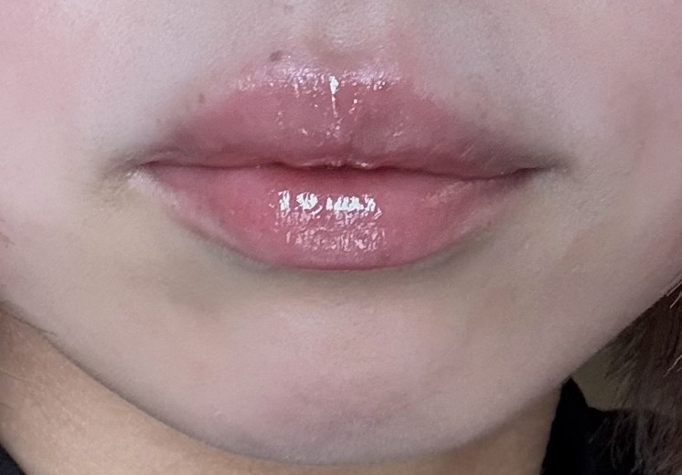 before photo: 口角ボトックス