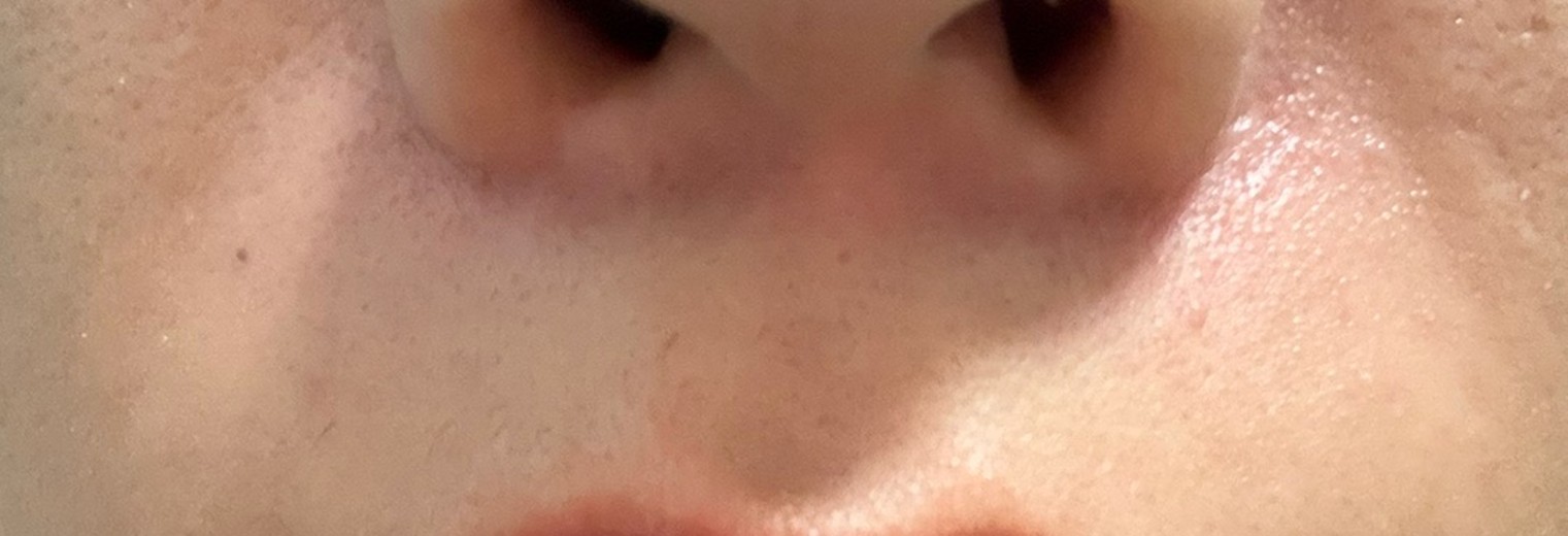 before photo: 인중제모