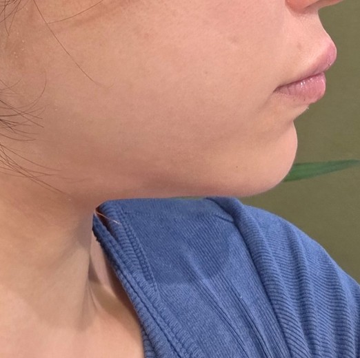 after photo: あごヒアルロン酸