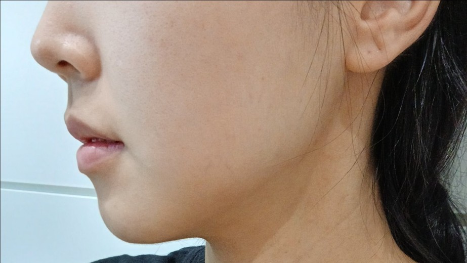 before photo: 인모드리프팅, 윤곽주사