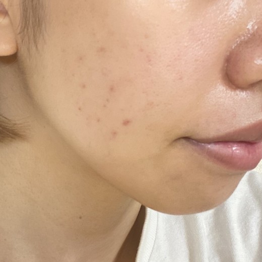 before photo: IPL(光/フォト治療)