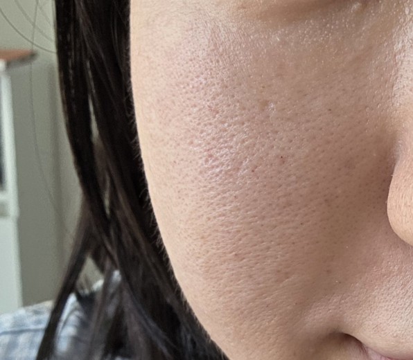 after photo: 리쥬란힐러, 쥬베룩