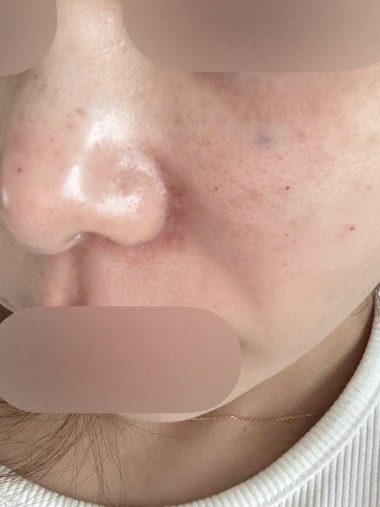 ハイドラフェイシャル｜全顔｜毛穴洗浄 | AELLE CLINIC 表参道