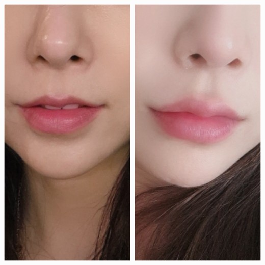 before photo: 입꼬리필러, 입술필러