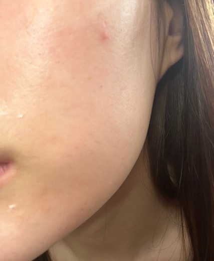 after photo: ダーマペン