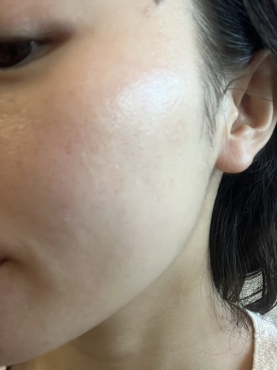 after photo: ララピール(LHAピーリング)