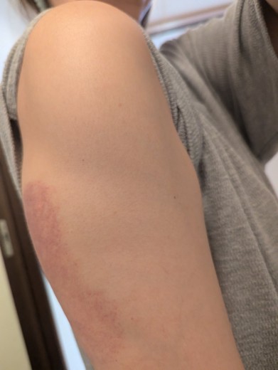 after photo: 脂肪冷却(腕)