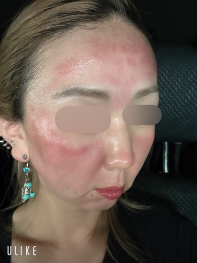 after photo: ダーマペン