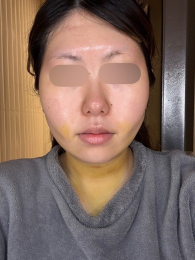 after photo: 糸リフト, 脂肪吸引(顎下), 脂肪吸引(顔), 脂肪吸引(頬)
