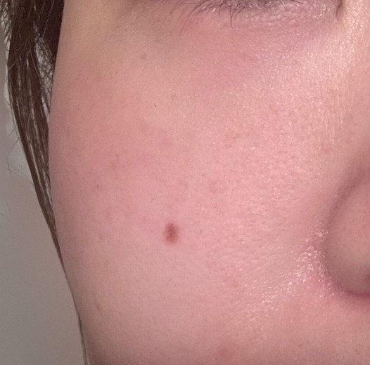 after photo: IPL(光/フォト治療)