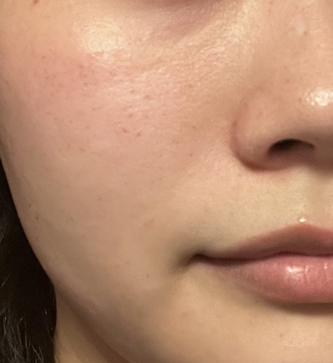 after photo: IPL(光/フォト治療), ルメッカ