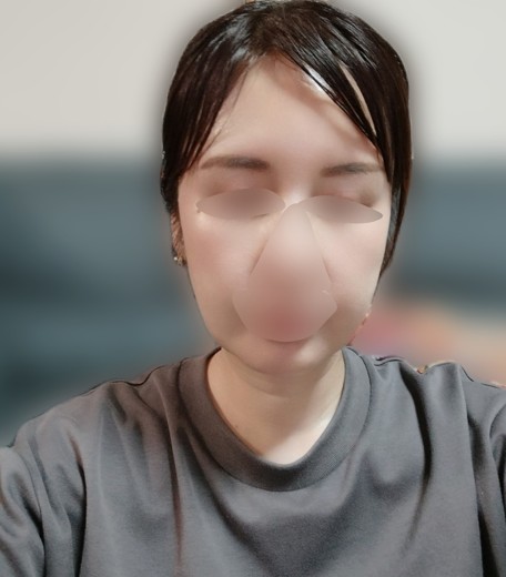 after photo: IPL(光/フォト治療), エレクトロポレーション