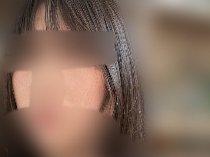 after photo: IPL(光/フォト治療)