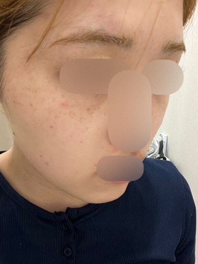 after photo: ルメッカ