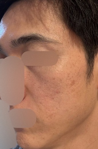 after photo: ピコフラクショナル