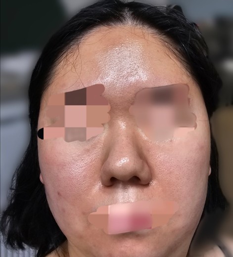 before photo: 아쿠아필링