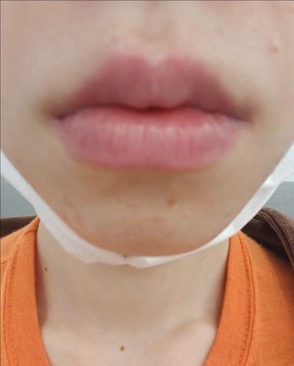 before photo: 입술필러