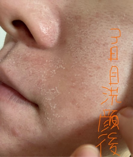 after photo: ダーマペン
