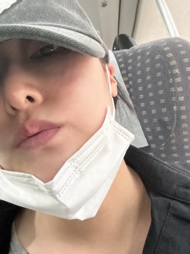 before photo: 리쥬란힐러