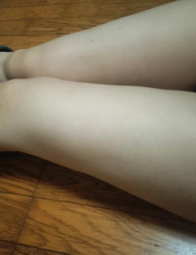 after photo: 脂肪冷却(太もも)