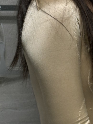 after photo: 팔지방흡입, 옆구리지방흡입, 복부지방흡입, 허리지방흡입