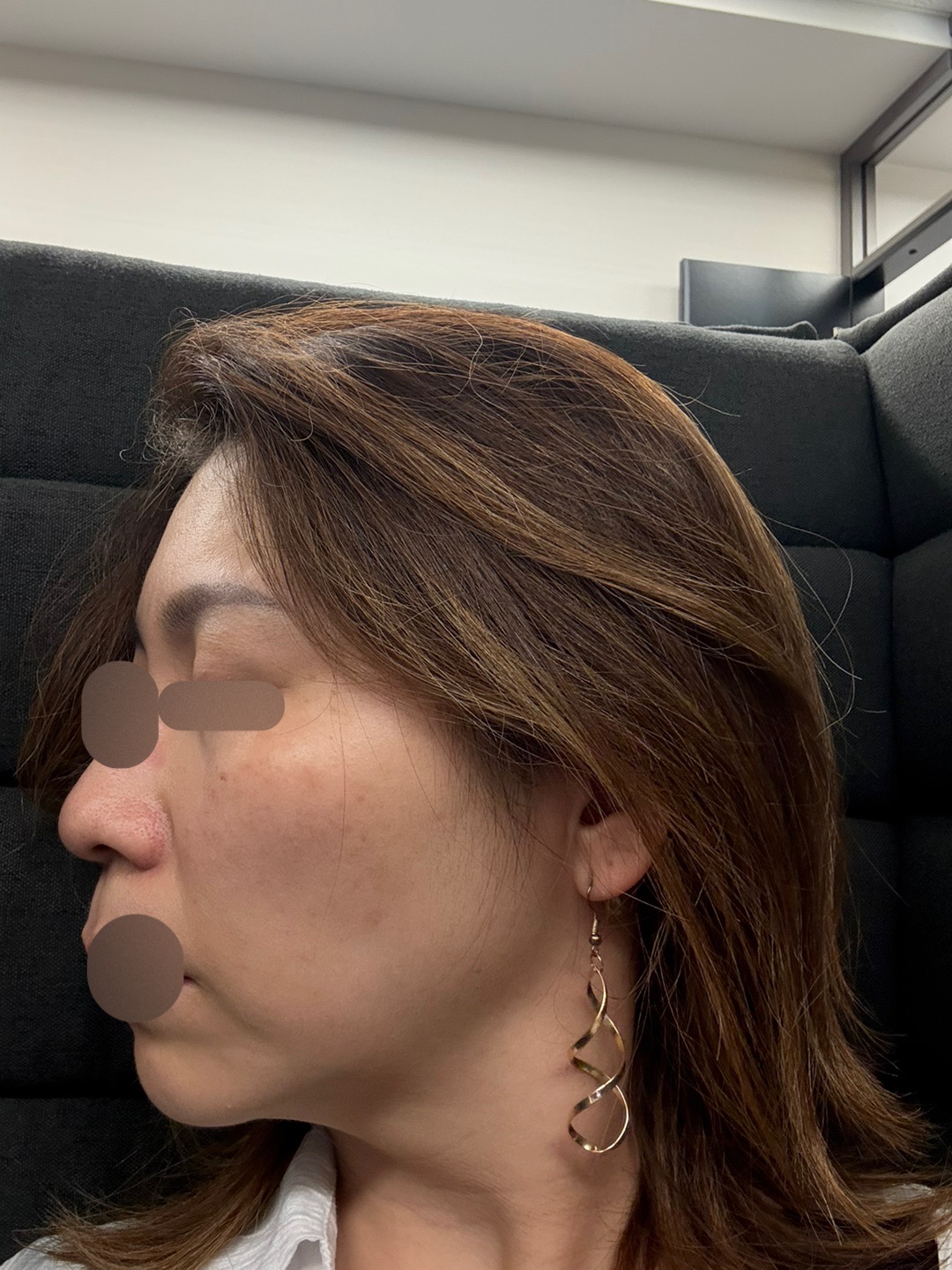 ピコトーニング＋イオン導入（ビタミンC or トラネキサム酸