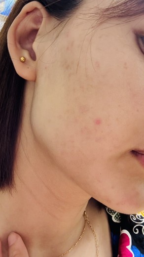 after photo: IPL(光/フォト治療), ピーリング, エレクトロポレーション