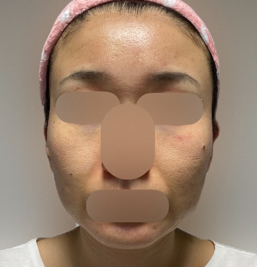 after photo: 白玉注射・点滴