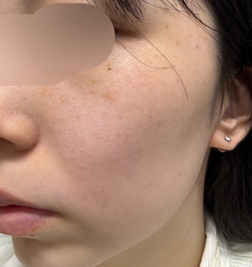 before photo: ハイドラフェイシャル