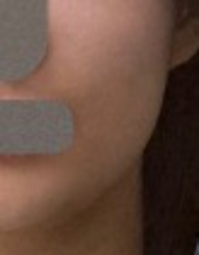 before photo: 사각턱보톡스