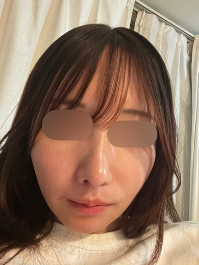 after photo: レーザートーニング