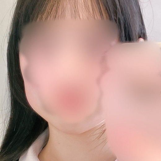 after photo: 脂肪溶解注射(顔)