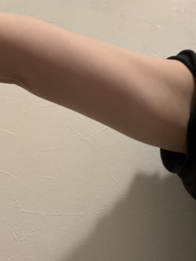 after photo: 脂肪溶解注射(腕)
