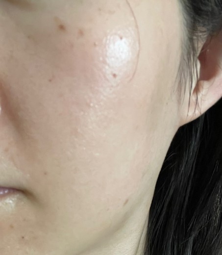 after photo: IPL(光/フォト治療)