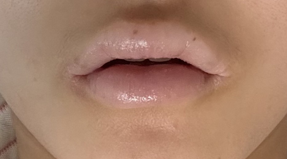 after photo: 입꼬리필러, 입술필러