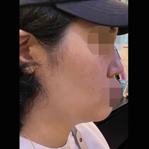 before photo: 콧볼축소