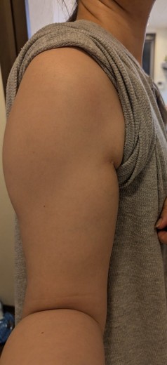 before photo: 脂肪冷却(腕)