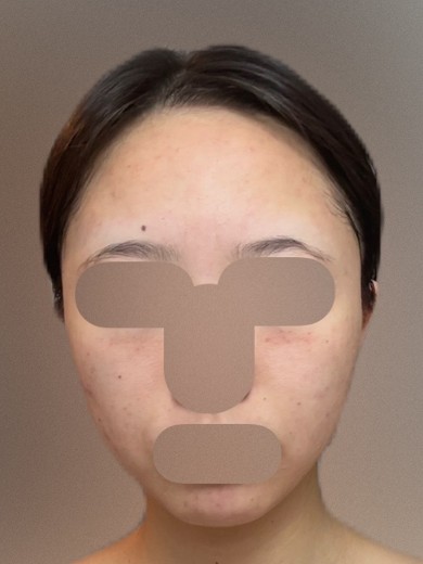 after photo: ダーマペン